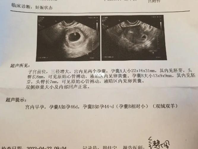 孕期孕囊偏左侧要小心,警惕出现胎儿发育不良或流产