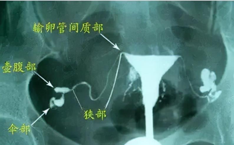 输卵管造影不会很痛苦，单次流程大概在半小时左右